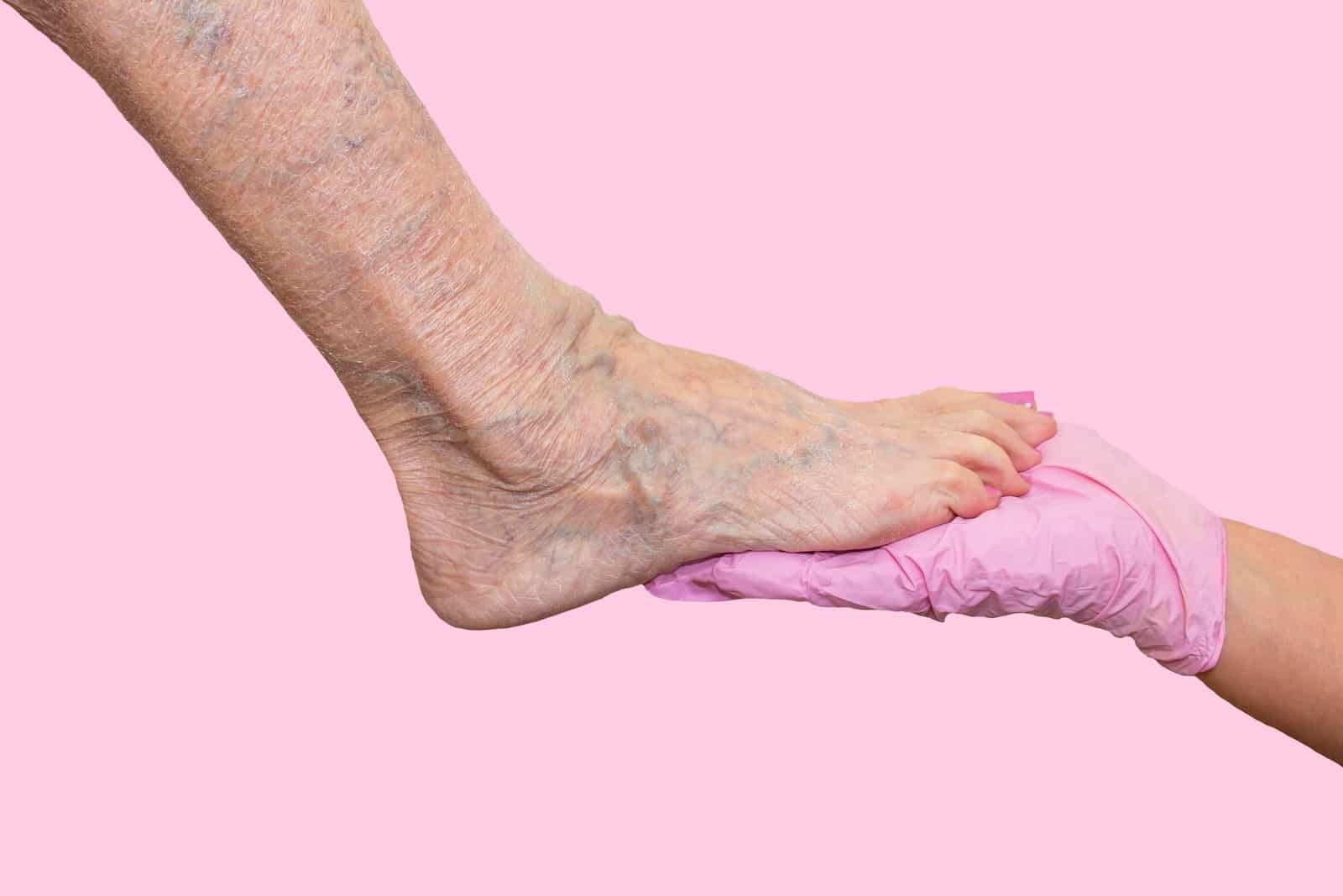 венозна недостатъчност